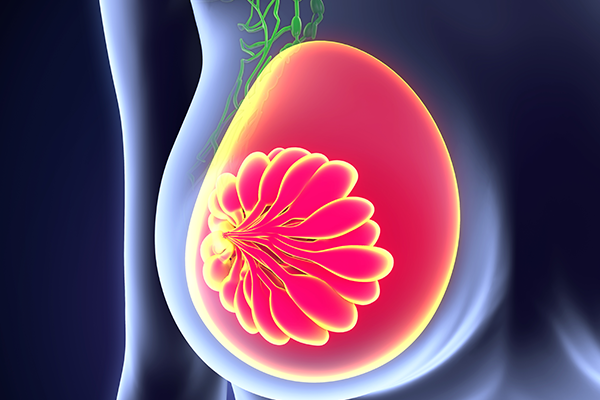 Breast cancer - Surgery
