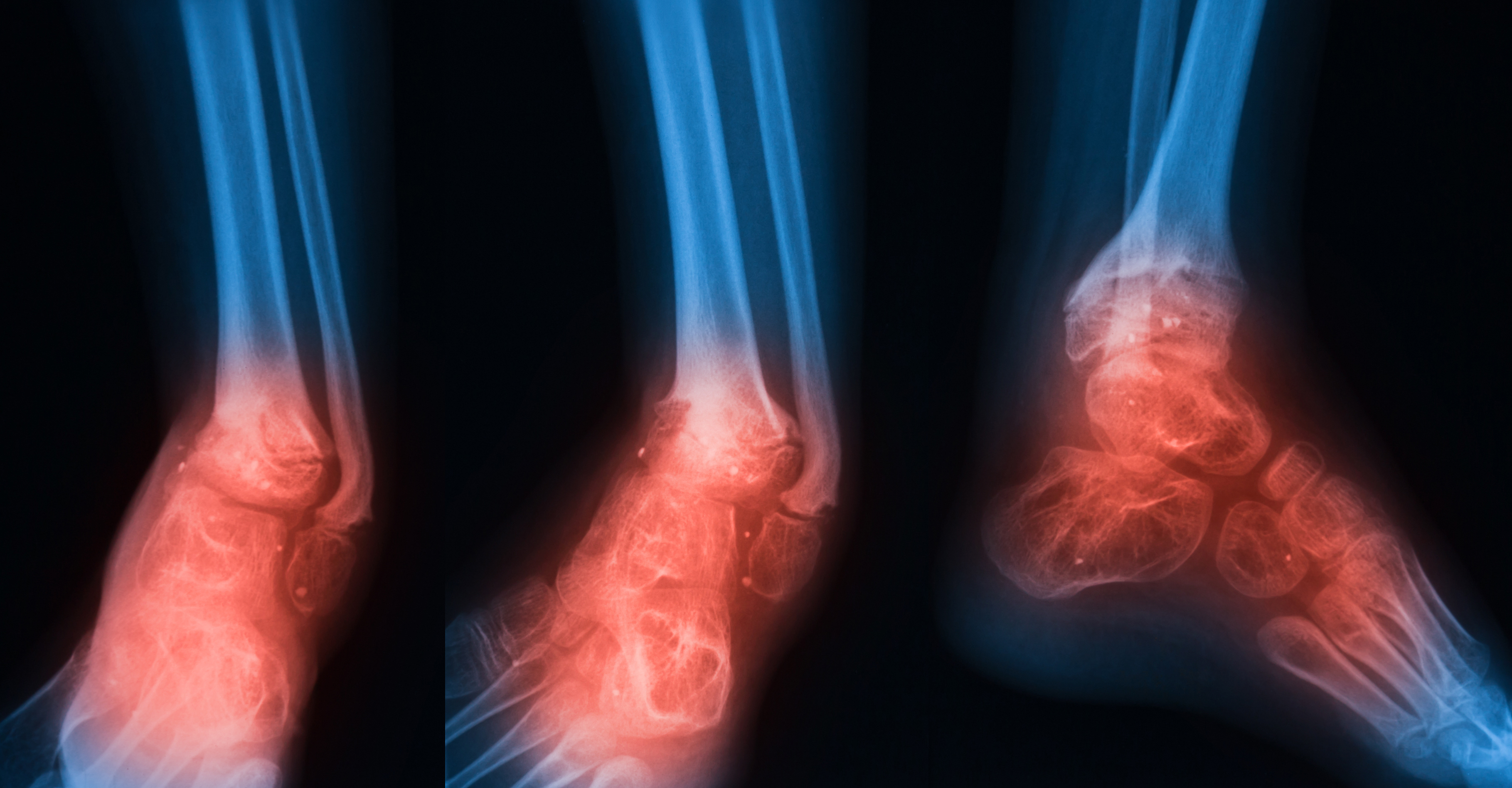 Diabetes Foot disease: An MDT approach to chronic diabetes foot disease management